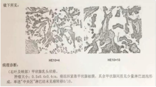 別慌，甲狀腺疾病還可以這樣投保！